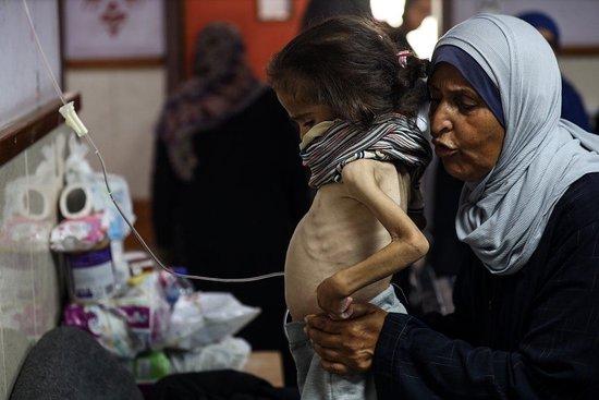 当地时间2024年6月1日，加沙地带代尔拜拉赫，巴以冲突持续，一名患有营养不良的巴勒斯坦儿童正在阿克萨烈士医院接受治疗。