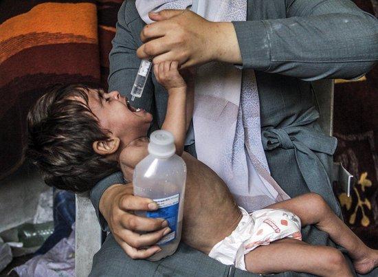 当地时间2024年6月9日，在加沙城的Jibaliya区，一名3岁的巴勒斯坦儿童Amjad Al-Qanoo在挣扎求生，他的健康状况因营养不良而恶化。