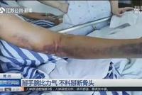 大学生比赛掰手腕 “吧嗒”一声手臂粉碎性骨折