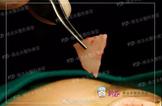 ▼鼻中隔+耳软骨鼻综合案例