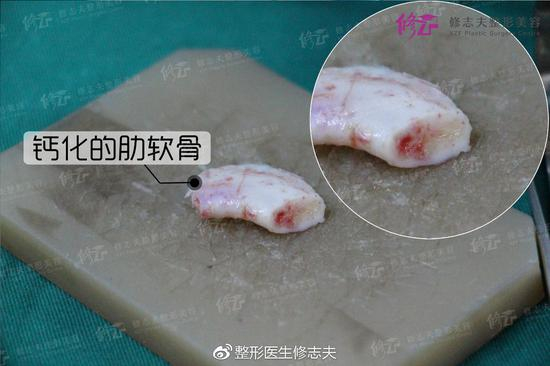 钙化后的肋软骨