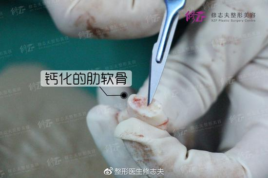 肋软骨钙化程度