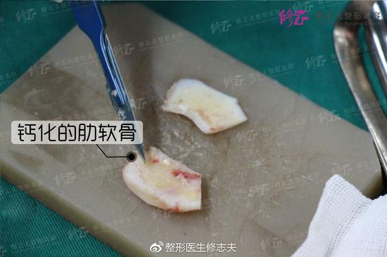 钙化的肋软骨 