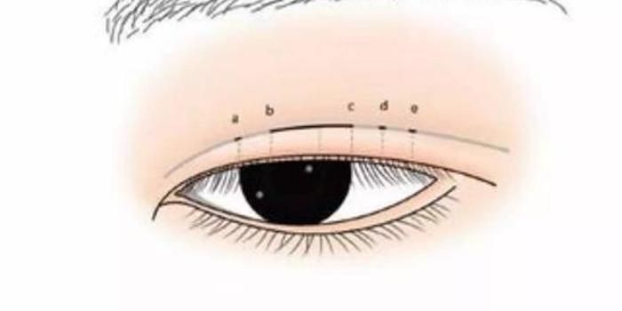 全切双眼皮多长时间能恢复 双眼皮消肿吃什么