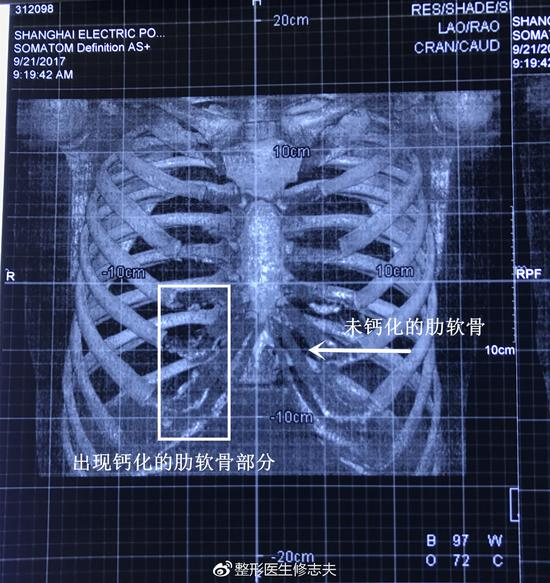 钙化肋软骨和未钙化肋软骨的影像区别