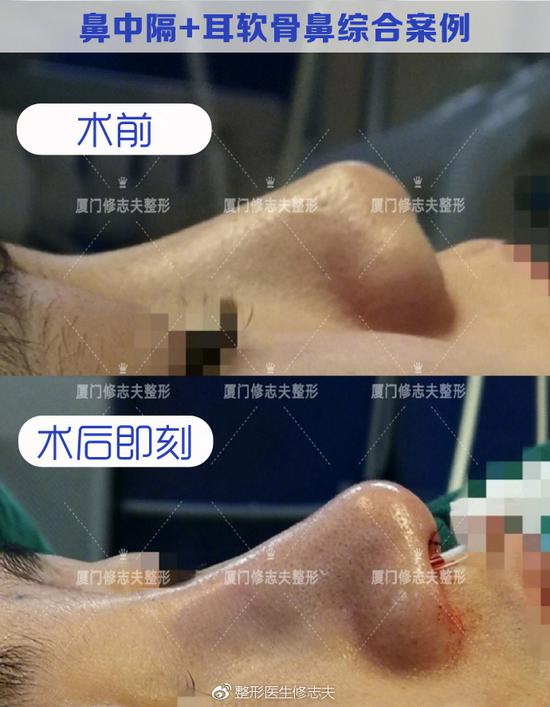 手术即刻
