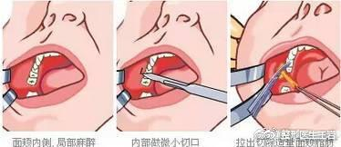 取颊脂垫示意