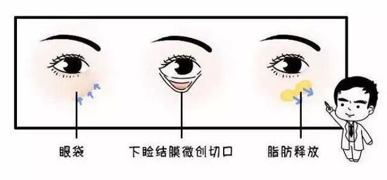 丨外路眶隔释放法