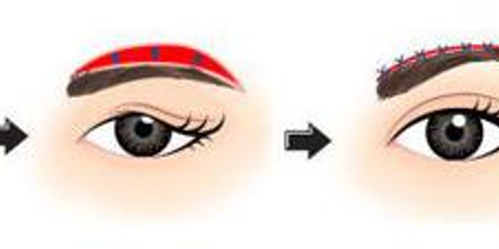 眉毛下垂怎么办 提眉术来拯救眉毛下垂_手机新浪网