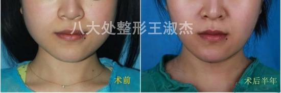 术后对比