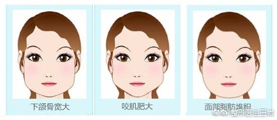 大脸类型