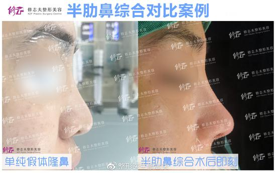自体肋软骨鼻综合案例