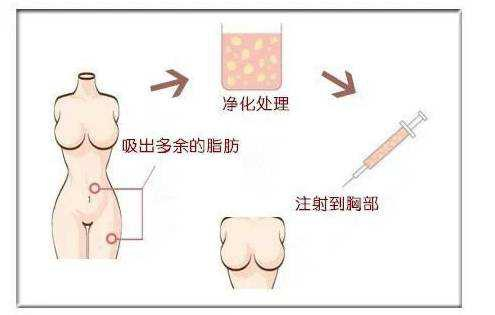 自体脂肪隆胸术