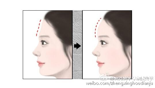 玻尿酸
