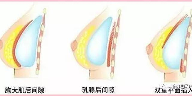 假体置入