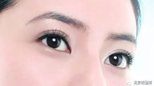 双眼皮
