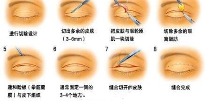 雙眼皮拆線會很疼嗎?