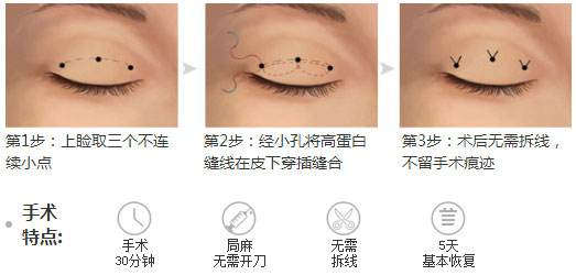 埋线双眼皮