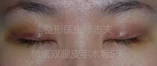 微痕双眼皮术后5天