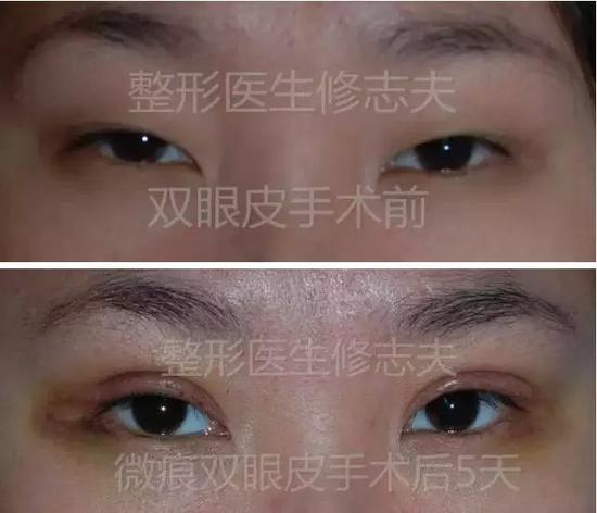 微痕双眼皮术后5天