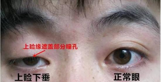 上睑下垂