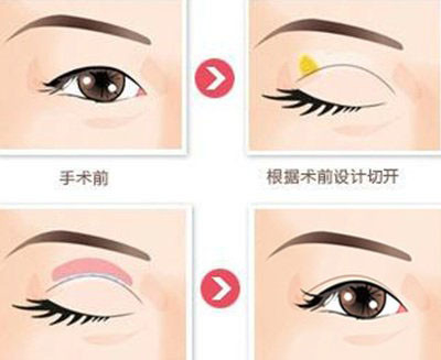 双眼皮切开法