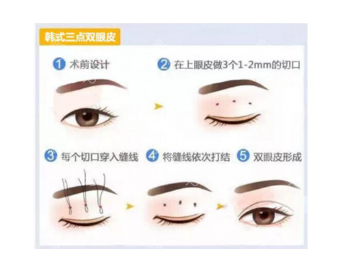 韩式三点双眼皮