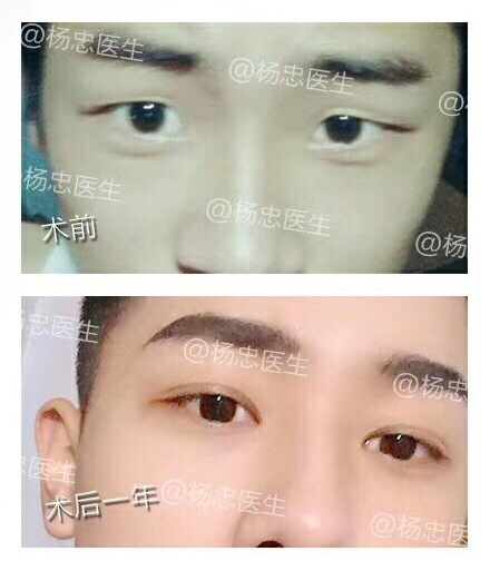 闭眼无痕双眼皮+开内眼角