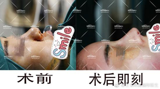 全肋软骨鼻综合