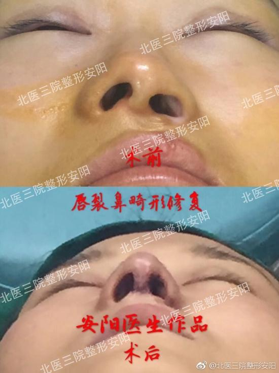 唇裂鼻畸形修复