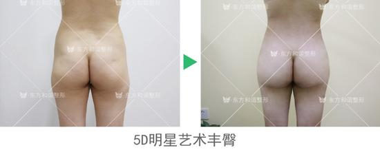 5D明星艺术臀雕
