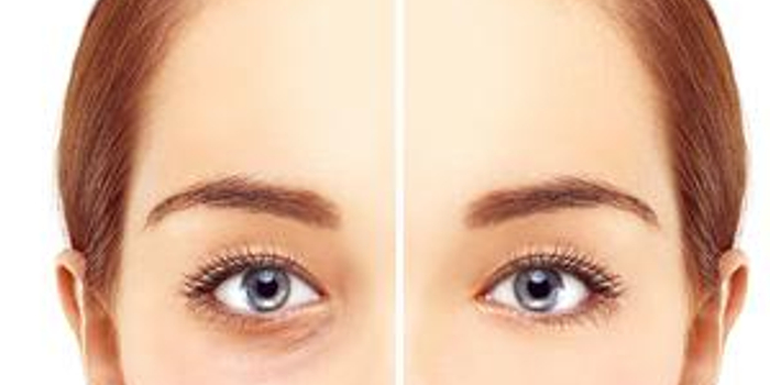 祛眼袋手术失败的表现有哪些 手机新浪网