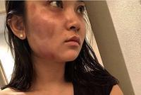 蒋劲夫对日本女友施暴 女方晒照脸部和手臂多处淤青