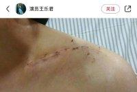 王乐君发文称《伪装者》拍摄期间被胡歌砸断了锁骨