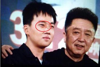 郭麒麟脸上伤疤惊人