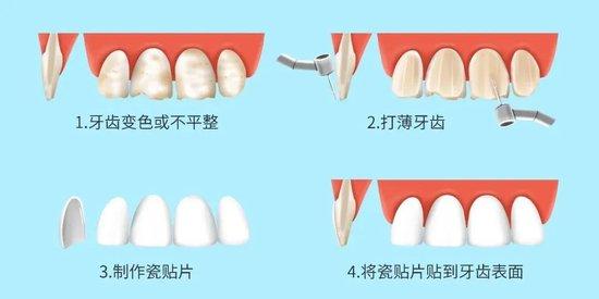 牙齿贴面的操作流程