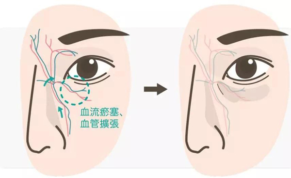 黑眼圈形成示意图