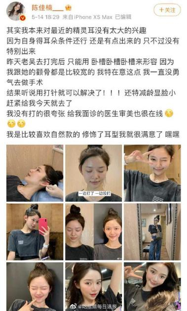 微博网红自述“精灵耳”手术