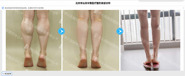 某医美诊所“小腿神经阻断术”宣传界面