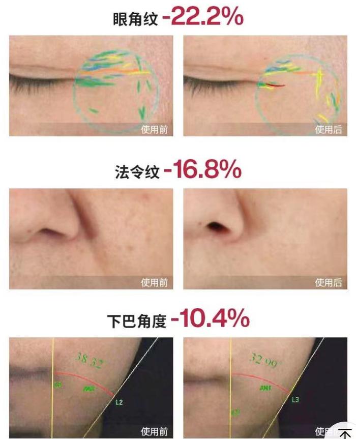 觅光疑虚假宣传、暗藏安全隐患？按Ⅲ类医疗器械监管为射频美容仪“乱飙”按下暂停键