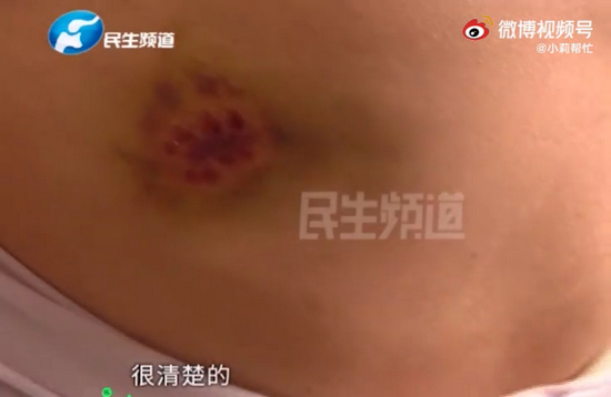 △老人被狗咬留下的伤痕（视频截图）