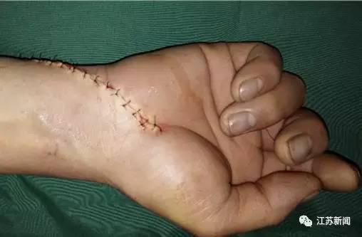  △ 缝合的伤口触目惊心（图 / 荔枝网）
