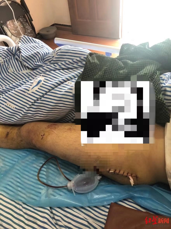 　　▲欧阳自伟的腿部伤痕