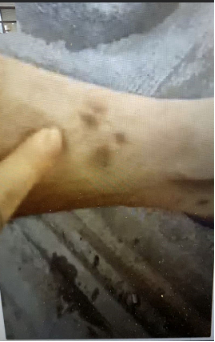 　袁小虎向记者展示自己左小腿被电棍灼伤的痕迹