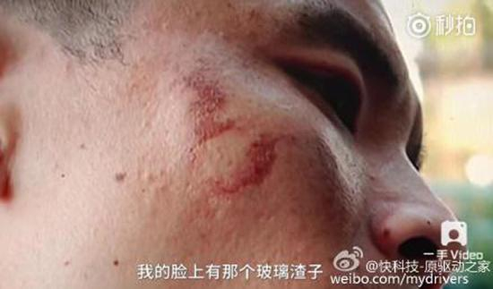 男子手部和脸部不同程度被炸伤。