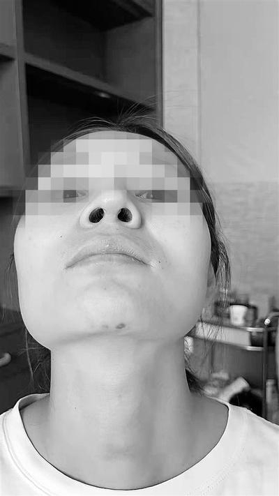 第一次在蓝山医疗美容院手术后第9个月的照片。