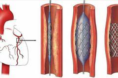 冠脉支架国家集采多款百元支架出炉 山东吉威等企业或中标