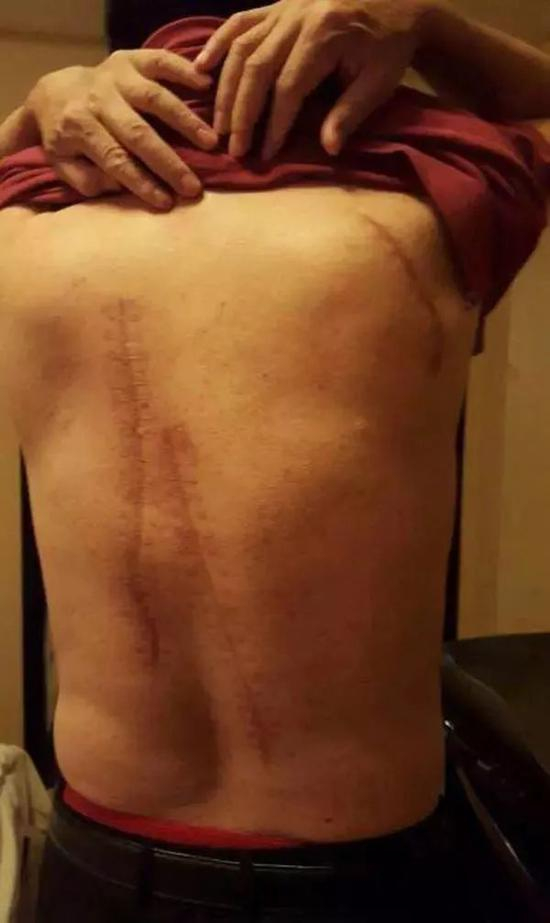 李耀清后背伤口（来源：澎湃）