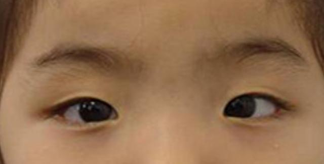 孩子眼珠挤到一起，是“对眼”吗？真假内斜视怎 么分？