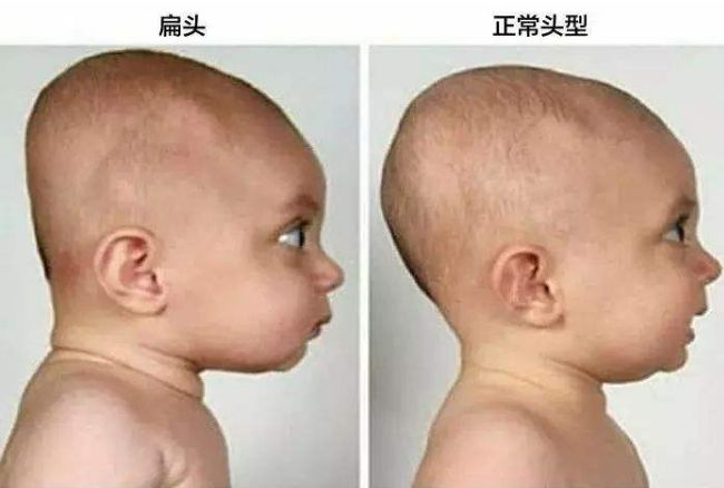 为何中国孩子多是扁头,外国孩子是圆头?不妨了解